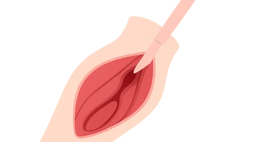 Compartment syndrome diagnosis and fasciotomy