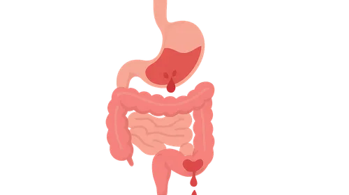 GI bleeding (upper and lower)