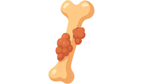Metastatic Bone Disease