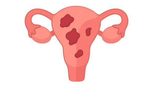 Endometriosis-Associated Pain