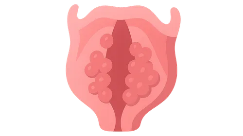 Laryngeal Papillomatosis