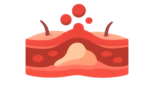 Acute Inflammation: Vascular Events