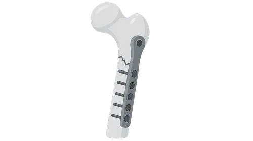 Biomechanics of Fracture Fixation