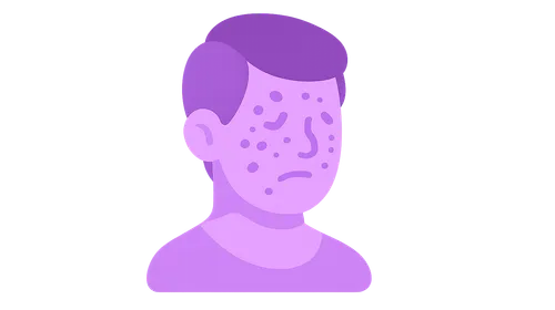 Systemic lupus erythematosus