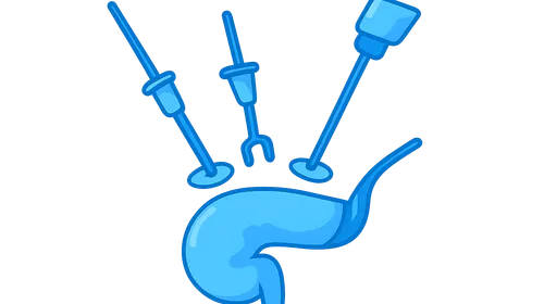 Laparoscopic Appendectomy