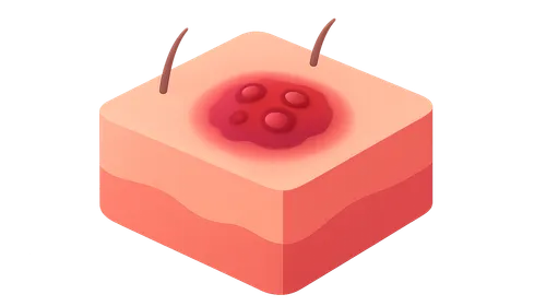 Soft Tissue Infections