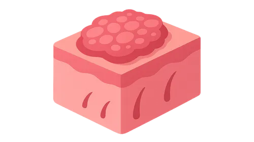 Pathophysiology of Psoriasis