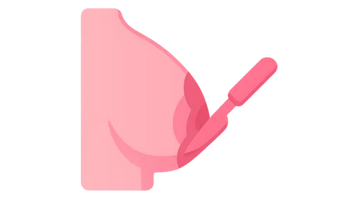 Surgical Management of Breast Cancer