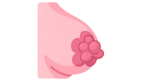 Benign Breast Diseases