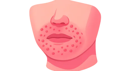 Perioral Dermatitis