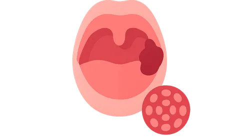 Oropharyngeal Cancer and HPV