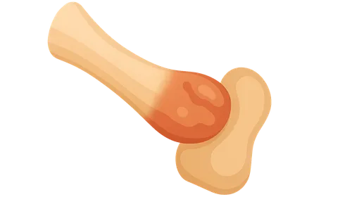 Diseases of Tendons and Fascia