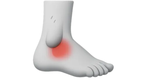 Ankle Sprains and Instability