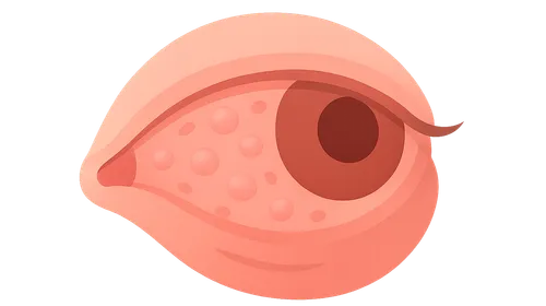 Conjunctivitis: Chronic