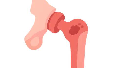 Infected Arthroplasty Management