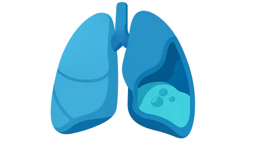 Empyema and pleural space infections