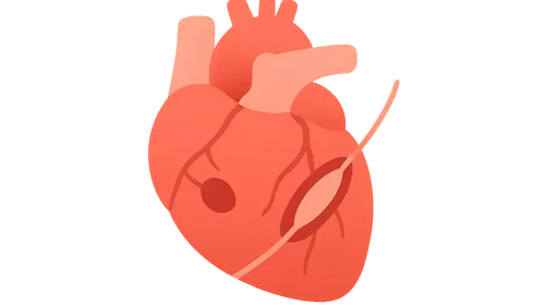 Reperfusion strategies