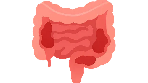Inflammatory bowel diseases