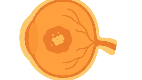 Age-Related Macular Degeneration