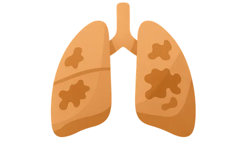 Idiopathic pulmonary fibrosis