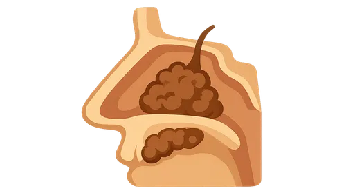 Allergic Fungal Sinusitis