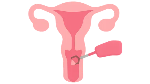 Cervical procedures (LEEP