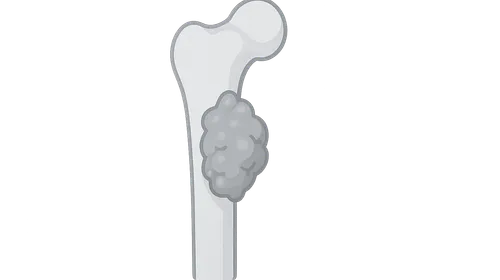 Tumor-Like Lesions of Bone