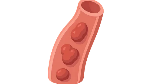 Antiphospholipid Syndrome