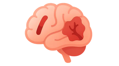Ischemic vs hemorrhagic stroke differentiation