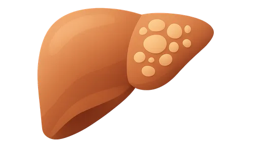 Alcoholic and Non-alcoholic Fatty Liver Disease