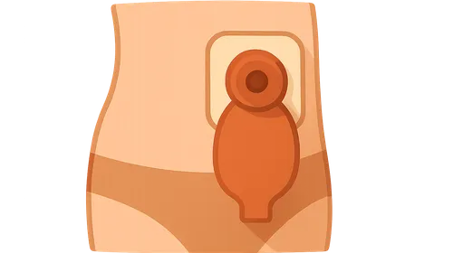 Ostomy creation and management