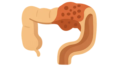 Necrotizing Enterocolitis
