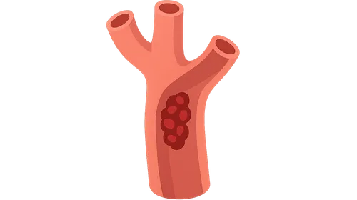 Venous Disease and Thrombosis