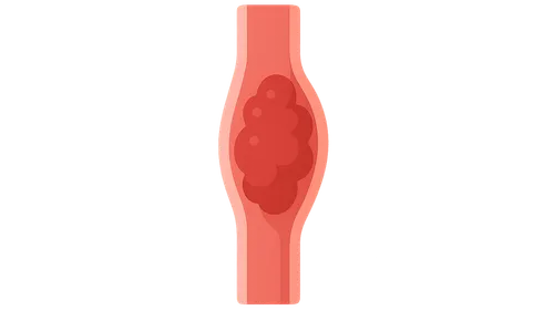 Venous thromboembolism