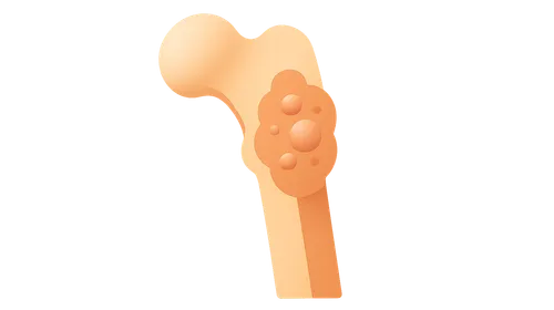 Bone Tumors and Tumor-like Lesions