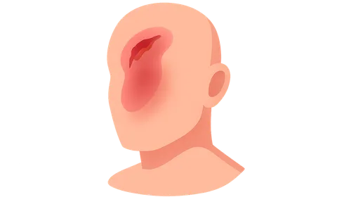 Blunt Force Injuries