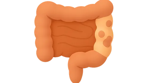 Inflammatory Bowel Disease