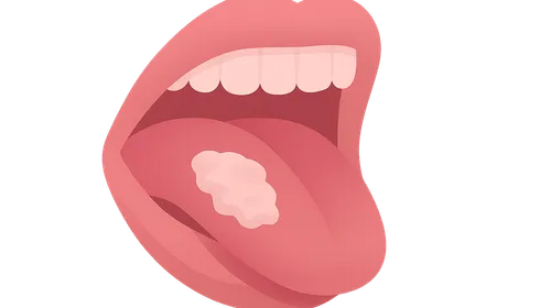 Oral Leukoplakia