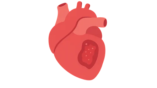 Infective endocarditis