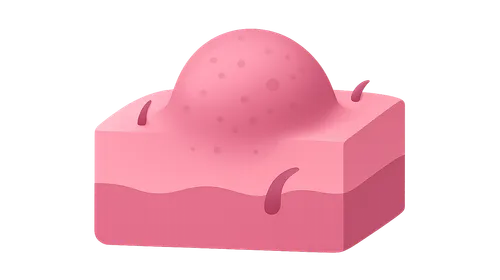 Premalignant Epidermal Tumors