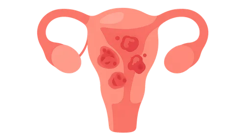 Postpartum Infections