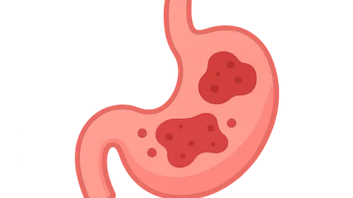 Intra-abdominal Infections