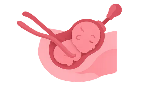 Operative Delivery (Forceps and Vacuum)