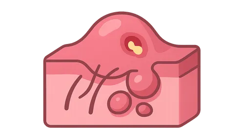 Hidradenitis Suppurativa