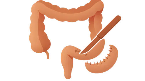 Surgical management in IBD