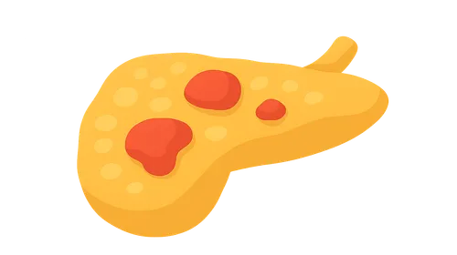 Acute pancreatitis etiology