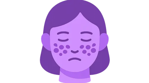 Systemic Lupus Erythematosus