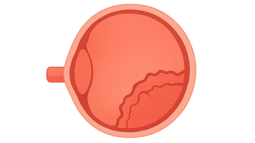 Retinopathy of Prematurity
