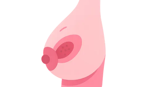 Breast conservation therapy