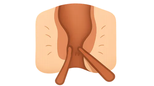 Anorectal procedures